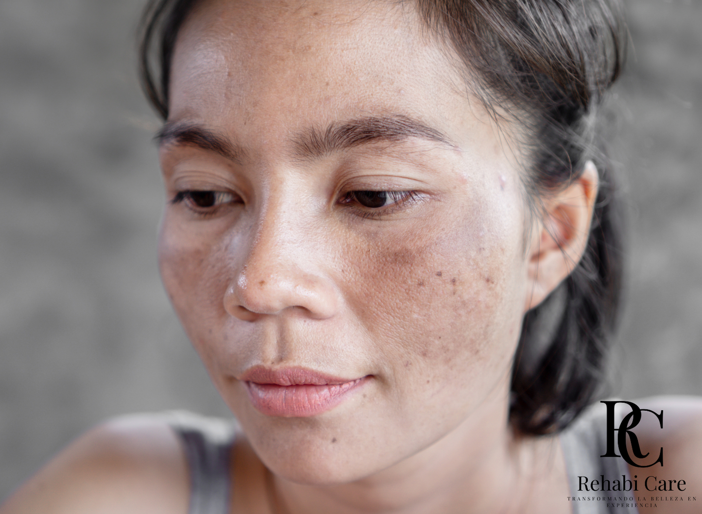 Manchas y Melasma