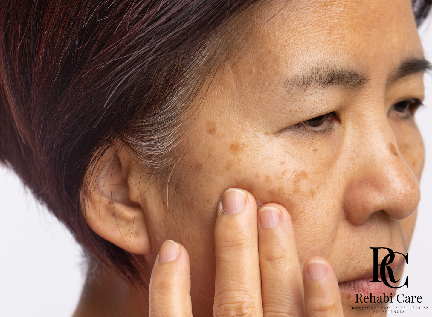 Melasma Resistente